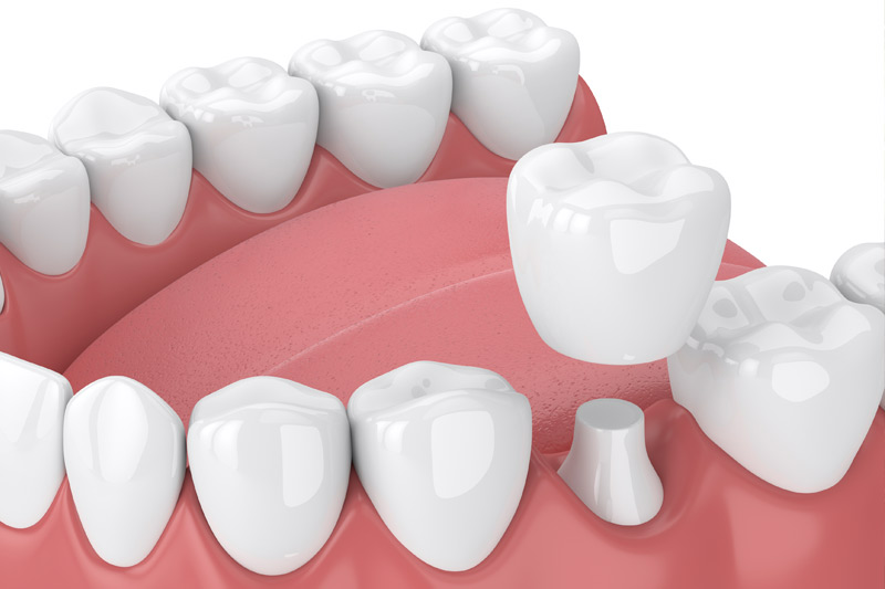 Dental Crowns in New York
